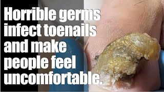 Horrible germs infect toenails and make people feel uncomfortableingrowntoenailremovalasmr [upl. by Ladd]