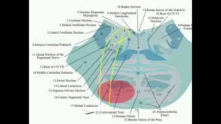 Millard Gublar syndrome [upl. by Fraase]