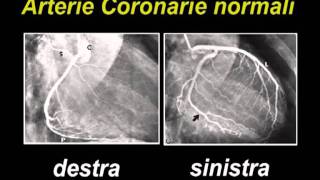 Coronarografia [upl. by Asli]