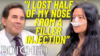 NonSurgical Nose Job Nightmare Melissa Lost Half Her Nose  Botched  E [upl. by Kayne]