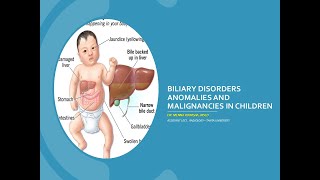 Biliary Disorders Anomalies and malignancies in children [upl. by Coke]