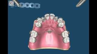 Ортодонтия и имплантация [upl. by Elayor]