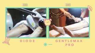 Diode vs Gentlemax Pro laser hair removal by Wink Laser Studio [upl. by Anirbus]