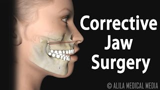 Corrective Jaw Orthognathic Surgery Animation [upl. by Inittirb]