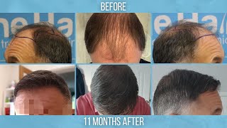 Norwood 5 FUE Hair Transplant by Dr Arshad [upl. by Carree]