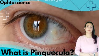 What is Pinguecula symptoms causes and treatment [upl. by Reyem383]