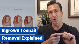 Ingrown Toenail Removal Dr Moore Explains the Permanent Cosmetic Procedure [upl. by Yanej]