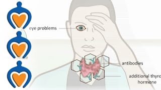 Schildklierproblemen  over de symptomen van hyperthyreoïdie hypothyreoïdie en struma [upl. by Ainit]