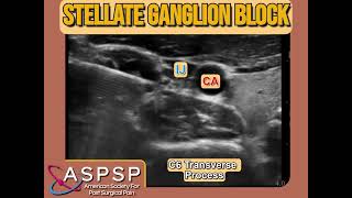 Ultrasound Guided Stellate Ganglion Block [upl. by Yemar]