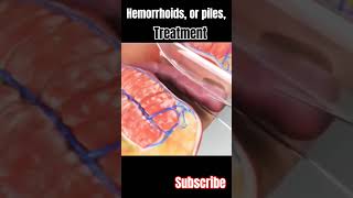 Hemorrhoids or piles surgery and treatment 3danimation viral short [upl. by Ahsatin]