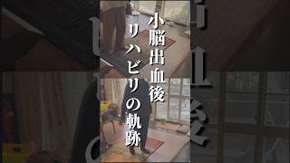 【小脳出血後リハビリの軌跡】手足の震えとバランス障害が顕著だったお客様 [upl. by Muhcan]