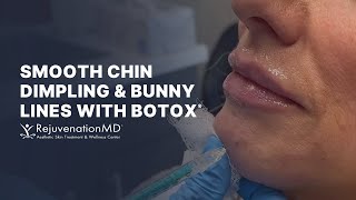 Botox for Chin Dimples and Bunny Lines [upl. by Hilaire452]