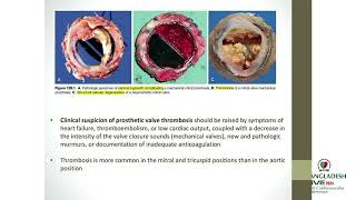 Echo Assessment of Prosthetic Heart Valves From Guidelinesto Daily Practices by Dr Shahana Zaman [upl. by Mastrianni]