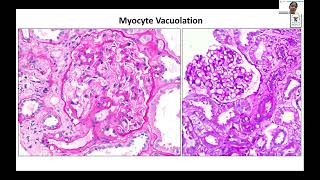 POST RENAL TRANSPLANT DRUG TOXICITY  Dr Vinita Agarwal Lec 9 [upl. by Oicneconi]