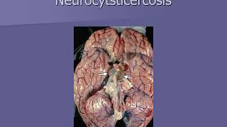 Neurocysticercosis neuroscience module [upl. by Bravin]