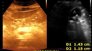 Cholelithiasis  Cholesterol polyp Moderate diffuse fatty Liver  Renal cortical cyst [upl. by Mialliw663]