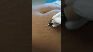 Stretch Marks Inkless Removal Boleyn Treatment Los Angeles 🌍 shorts [upl. by Adamik371]