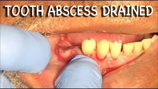 Infected Tooth Abscess Drained  Graphic⚠️ [upl. by Martita]