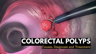 Colorectal Polyps Causes Signs and Symptoms Diagnosis and Treatment [upl. by Emmons]