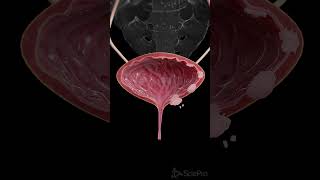 🩺 Understanding the Stages of Bladder Cancer 🩺 [upl. by Iamhaj]