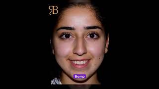 Nose surgery with Dr Bashartizadehجراحی بینی با دکتر بشارتی زاده [upl. by Parke658]