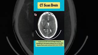 Subarachnoid hemorrhage SAH mri brain radiology shorts [upl. by Kistner]