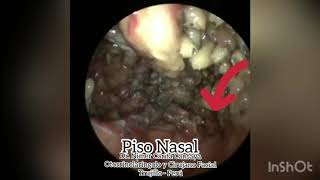 Miasis Nasal  Nasal Myiasis Dr Nimer Carita Trujillo Perú [upl. by Rosalie870]