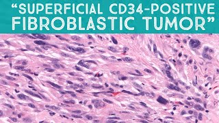 quotSuperficial CD34positive fibroblastic tumorquot  a mimic of sarcoma AIP France 2021  Case 15 [upl. by Eardnoed732]