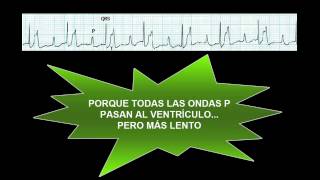 CURSO DE ELECTROCARDIOGRAFIA 39  BLOQUEO AV DE PRIMER GRADO [upl. by Kowtko]