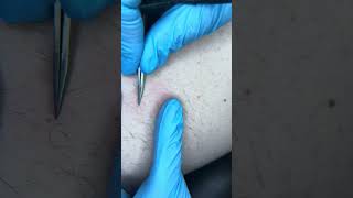 Watch electrolysis Permanent removal of stubborn back hairs [upl. by Editha]