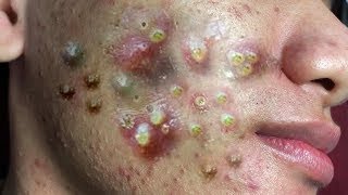 Big Cystic Acne Blackheads Extraction Blackheads amp Milia Whiteheads Removal Pimple Popping  2708 [upl. by Christel889]