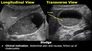 Gallbladder Ultrasound Reporting  GB Disease Scan Reports  How To Write USG Report  Abdominal USG [upl. by Veedis]