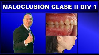 MALOCLUSION CLASE 2 DIVISION 1 DE ANGLE  ORTODONCIA [upl. by Newman212]