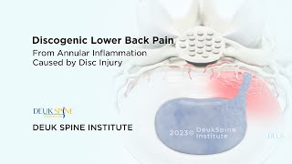 Discogenic Lower Back Pain  3D Animation [upl. by Varick]