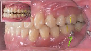 Non Extraction Treatment of CIII Malocclusion with invisalign｜【Chris Chang Ortho】CC677 [upl. by Cirderf]