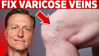 How to Treat Varicose Veins Naturally – Dr Berg [upl. by Aihsenot895]