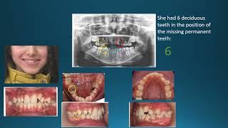 Orthodontic Case Report Hypodontia [upl. by Phylys]