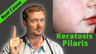 KERATOSIS PILARIS Fix Sign of Serious Condition Chicken Skin Cure [upl. by Ahtael]