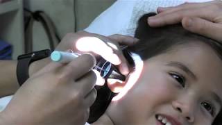 Awake Ear Tube Placement In Children [upl. by Auohs]