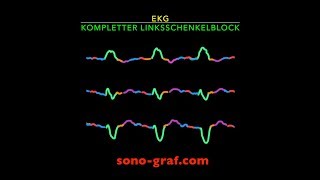 EKG Linksschenkelblock [upl. by Collar]