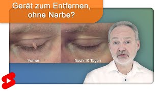 Fibrome ohne Narbe und Betäubung entfernen Shorts [upl. by Courtland14]