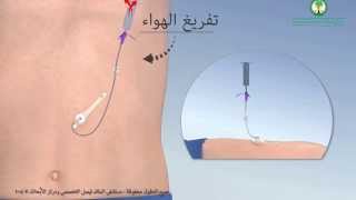 Gastrostomy Feeding Tube أنبوب التغذية ميكي عبر جدار البطن [upl. by Ezra]