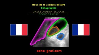 Échographie  Boue de la vésicule biliaire [upl. by Veator]