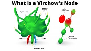 What Is a Virchows Node [upl. by Ahseya803]