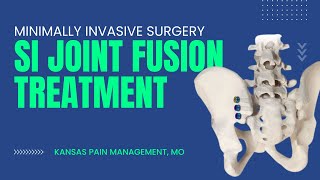 Minimally Invasive Surgery SI Joint Fusion Treatment for Back Pain  Kansas Pain Management [upl. by Valley252]