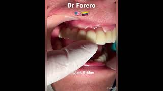 Implant bridge implantes dentales con Puente fijo en Circonio Dr ForeroBogota Colombia [upl. by Dream221]