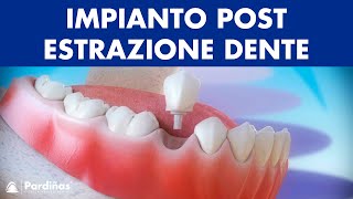 Impianto dentale immediato postestrazione dente © [upl. by Charbonnier]