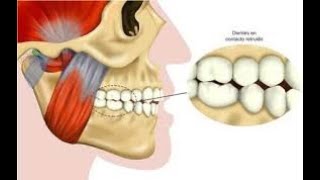 Rechinido dental [upl. by Allerym266]