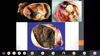 germ cell tumors of the ovary [upl. by Skier866]