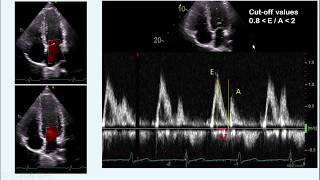 diastolic dysfunction part I  concept amp measurement [upl. by Ellenwad]